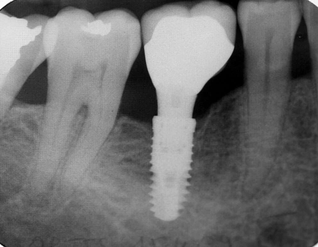 Implant dentaires
